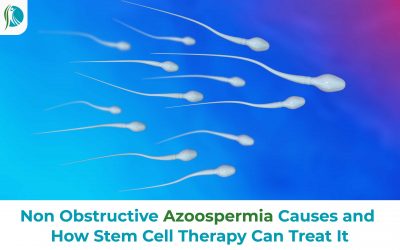 Non Obstructive Azoospermia Causes and How Stem Cell Therapy Can Treat It